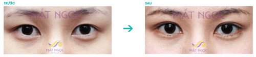 Giải pháp khắc phục mắt không đều - 2