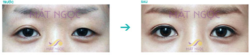 Giải pháp khắc phục mắt không đều - 4