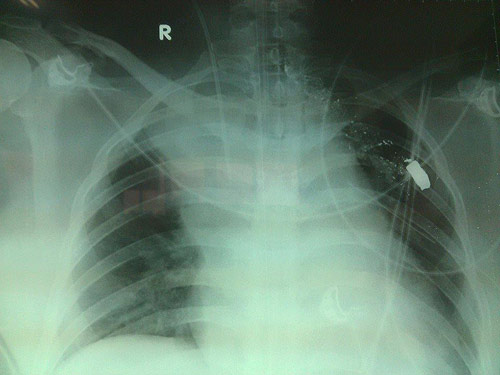 Vụ thai phụ bị bắn ở Lào: Mẹ nguy kịch, con tử vong - 2