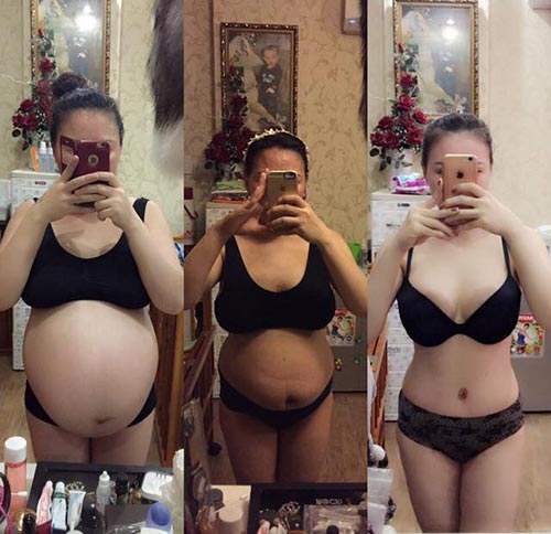 9x hai con kể chuyện đi cắt mỡ thừa ở bụng sau sinh - 2