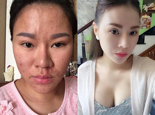 9x hai con kể chuyện đi cắt mỡ thừa ở bụng sau sinh - 3