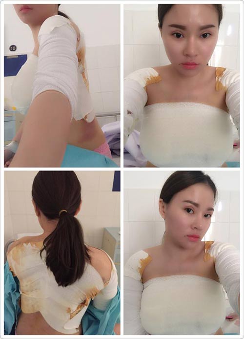 9x hai con kể chuyện đi cắt mỡ thừa ở bụng sau sinh - 10