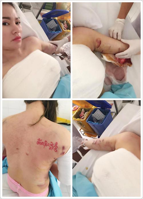 9x hai con kể chuyện đi cắt mỡ thừa ở bụng sau sinh - 9