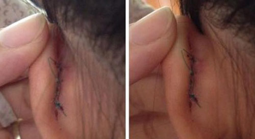 Bị cô giáo véo tai, học sinh lớp 2 phải khâu 2 mũi - 1