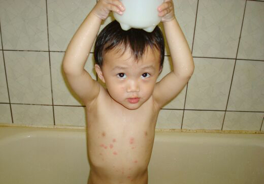 7 thực phẩm trẻ bị thủy đậu cần quot;tránh xaquot; - 2