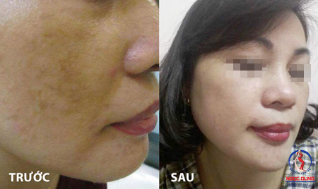 Nguyên nhân trị nám hoài không hết - 2