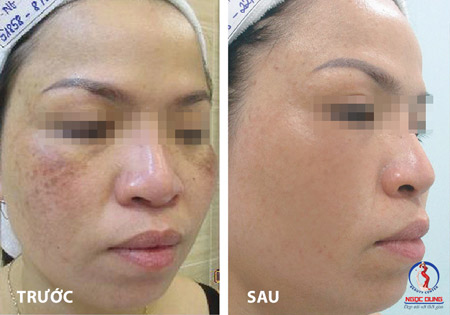 Nguyên nhân trị nám hoài không hết - 3
