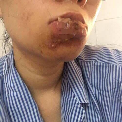 Xót xa cô gái Quảng Ninh phải cắt bỏ môi sau khi tiêm chất làm đầy - 3