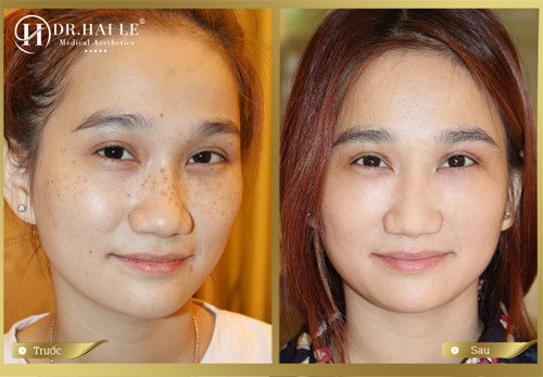 quot;Tháng vàng tri ân” tặng tới 50% phí làm đẹp tại Dr.Hải Lê - 3