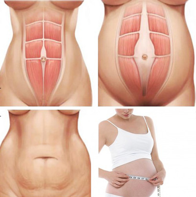 Ly Kute “gây mê” với vòng eo phẳng lì sau sinh mổ - 5