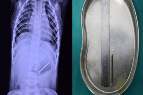 Để con cho bà nội trông, mẹ ân hận vì phát hiện dị vật trong bụng con - 1