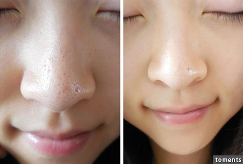 Không cần nặn, mụn đầu đen sẽ tự chui ra chỉ với 1 quả chanh - 1
