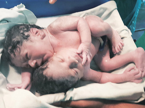 Cặp song sinh dính liền chào đời với nụ hôn trao nhau - 2