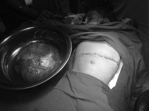 Bé gái 1 tuổi mang bầu bào thai ký sinh 3,5kg khiến cha mẹ hoảng loạn - 2