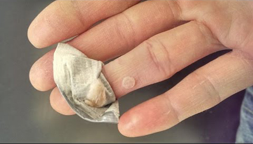 Trị mụn cóc cứng đầu bằng vài nhánh tỏi, bạn đã biết chưa? - 4