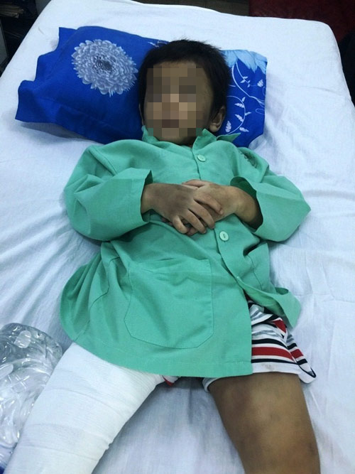 Bé 4 tuổi gãy xương đùi vì mẹ ruột, bố dượng đánh - 1