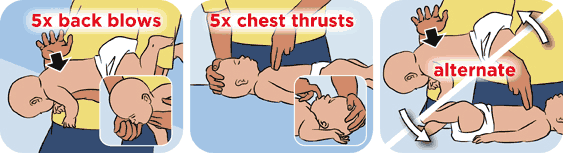 Cha mẹ phải biết cách sơ cứu khi trẻ bị hóc dị vật - 4