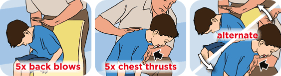 Cha mẹ phải biết cách sơ cứu khi trẻ bị hóc dị vật - 5
