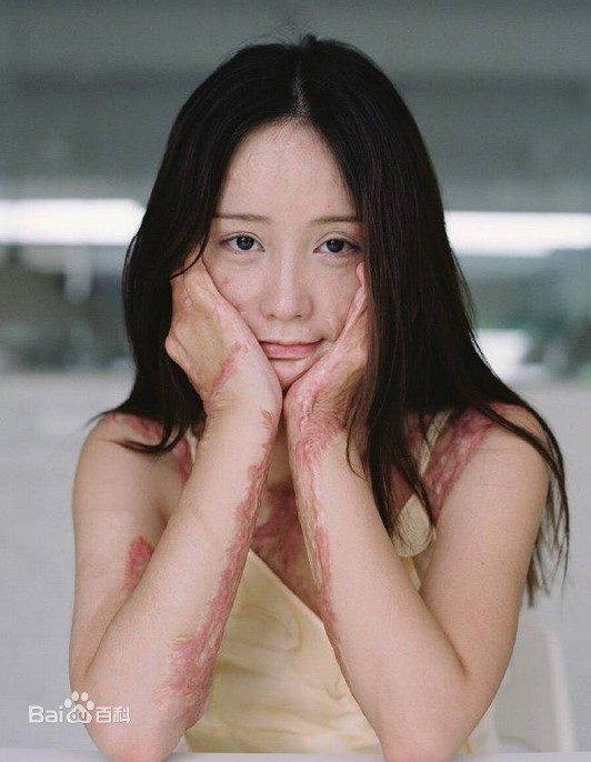 Sau 5 năm, người mẫu teen Trung Quốc từng bị thiêu sống vì tình lộ diện - 1