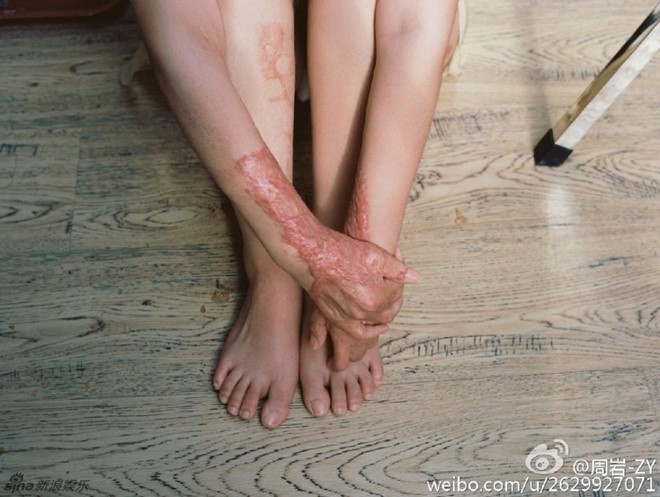Sau 5 năm, người mẫu teen Trung Quốc từng bị thiêu sống vì tình lộ diện - 5