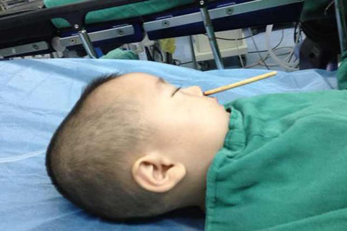 Đồ vật quen thuộc trong mâm cơm của các gia đình lại là “sát thủ” với trẻ nhỏ - 4