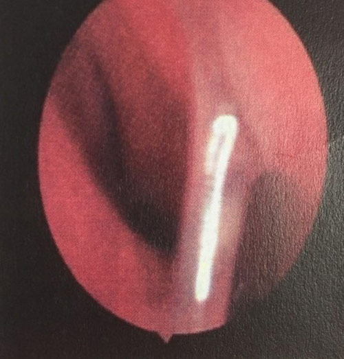 Đồ vật quen thuộc trong mâm cơm của các gia đình lại là “sát thủ” với trẻ nhỏ - 1