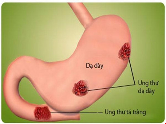 Nguyên nhân và cách phát hiện sớm ung thư dạ dày - 1