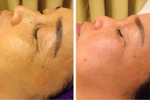 Sở hữu làn da đẹp từ Vi kim sinh học tế bào gốc Raphitox - 5