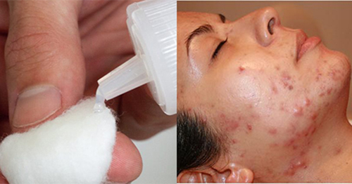 4 công dụng làm đẹp quot;thần thánhquot; ít người biết của cồn y tế - 2