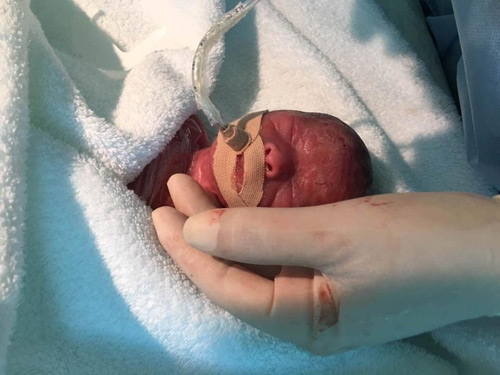 Cặp song sinh bé bằng bàn tay sống sót thần kỳ - 1