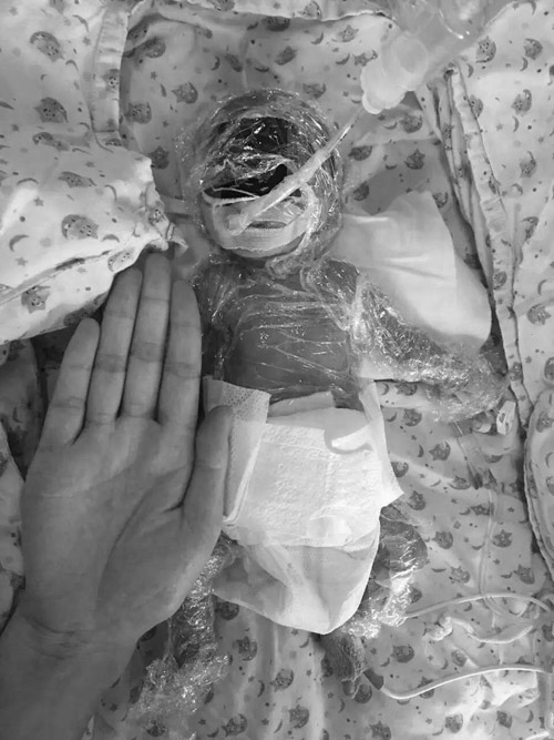 Cặp song sinh bé bằng bàn tay sống sót thần kỳ - 3