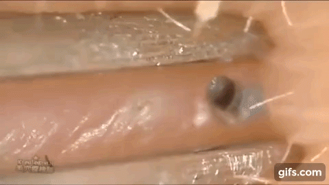 Clip nặn mụn đầu đen thu hút hàng triệu lượt xem chỉ trong một ngày - 1