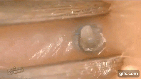 Clip nặn mụn đầu đen thu hút hàng triệu lượt xem chỉ trong một ngày - 5