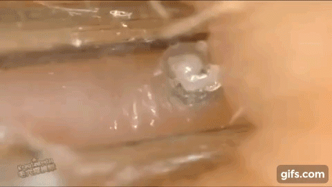 Clip nặn mụn đầu đen thu hút hàng triệu lượt xem chỉ trong một ngày - 7