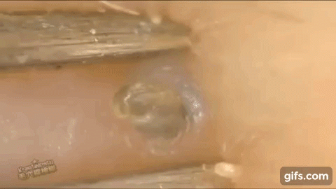 Clip nặn mụn đầu đen thu hút hàng triệu lượt xem chỉ trong một ngày - 11