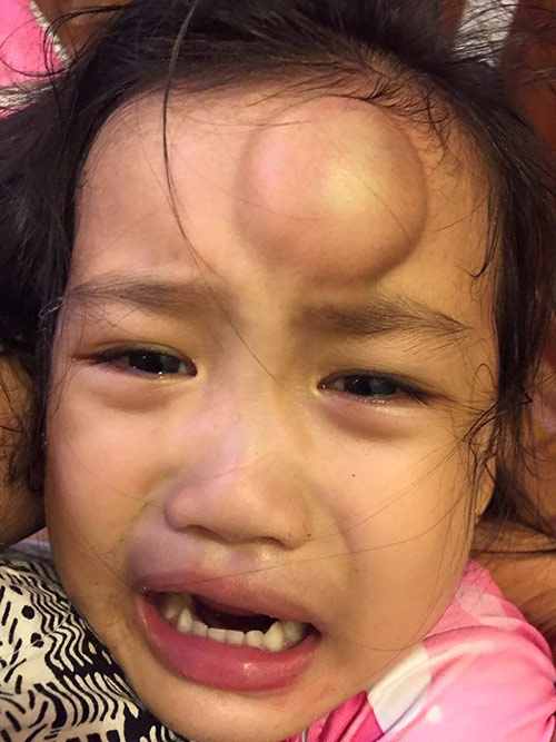Ốc Thanh Vân hốt hoảng với khuôn mặt có cục sưng “to như quả ổi” của con gái - 1