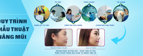 Tút lại nhan sắc mùa lễ hội cùng chiếc mũi S-line quyến rũ - 4