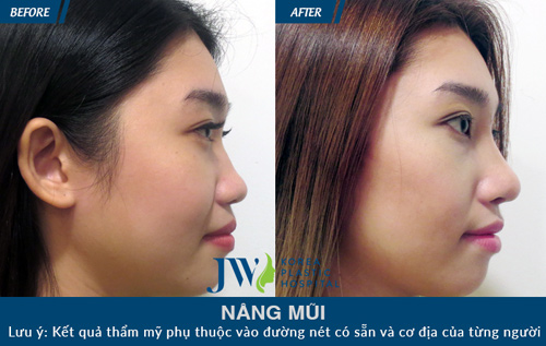 Tút lại nhan sắc mùa lễ hội cùng chiếc mũi S-line quyến rũ - 5