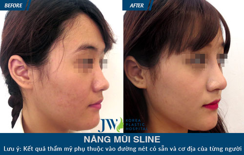 Tút lại nhan sắc mùa lễ hội cùng chiếc mũi S-line quyến rũ - 6