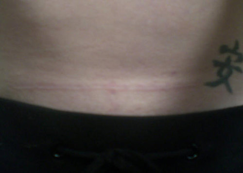 Đây là hình ảnh chân thực về sự thay đổi của vết sẹo sinh mổ từ 1 ngày đến 2 năm - 6
