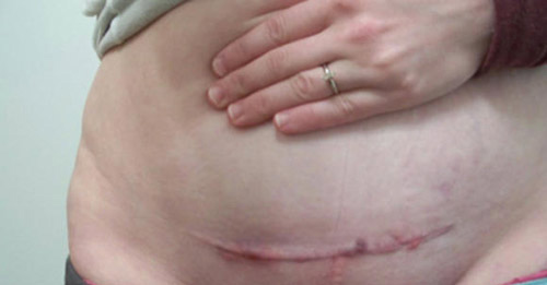 Đây là hình ảnh chân thực về sự thay đổi của vết sẹo sinh mổ từ 1 ngày đến 2 năm - 4