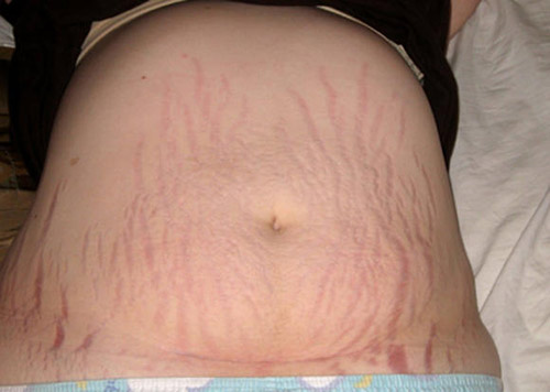 Đây là hình ảnh chân thực về sự thay đổi của vết sẹo sinh mổ từ 1 ngày đến 2 năm - 8