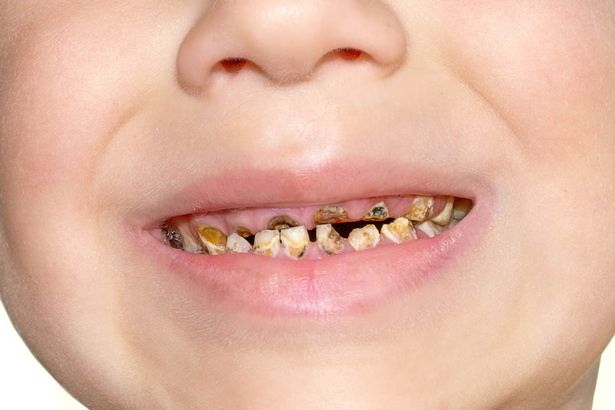Ăn nhiều nho khô, trẻ vô tình bị hỏng hàm răng xinh - 2