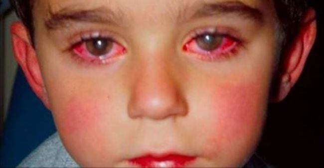 Vì chiếc bút đồ chơi quen thuộc, cậu bé 14 tuổi suýt mù cả đôi mắt - 1