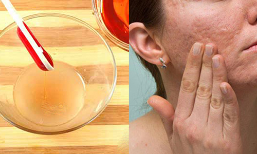 Sẹo lồi khó chữa đến mấy cũng “xẹp” ngay với hỗn hợp này - 7