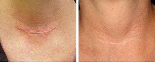 Sẹo lồi khó chữa đến mấy cũng “xẹp” ngay với hỗn hợp này - 8