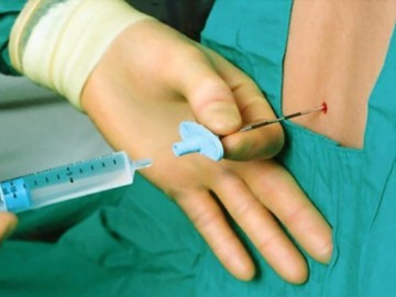 Gây tê tủy sống khi sinh bị đau lưng: Lý giải của chuyên gia các mẹ cần biết