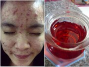 Làm đẹp - Liệt kê công dụng làm đẹp của dầu gấc sẽ khiến bạn chạy ngay đi mua 1 lọ về