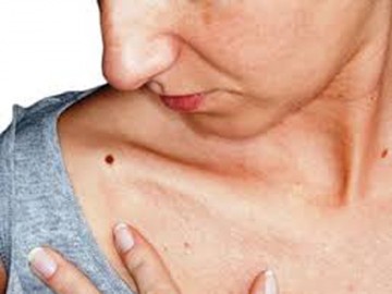 Nốt ruồi trên cơ thể: khi nào cần lo lắng?