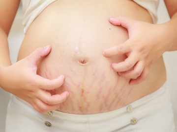 2 mẹo trị rạn da hiệu quả chưa đến 10 ngàn, hữu ích với chị em sau sinh